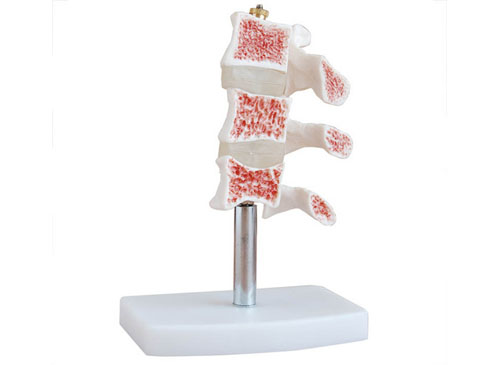 脊椎典型病变模型