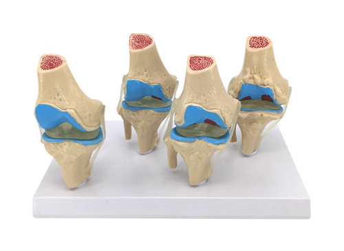 四阶段病变膝关节模型