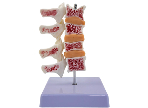 脊椎典型病变模型