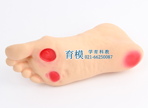 高级糖尿病足护理模型